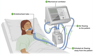 Different Types of Ventilators